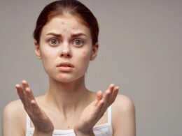 Czy oczyszczanie twarzy pomaga w leczeniu trądziku?